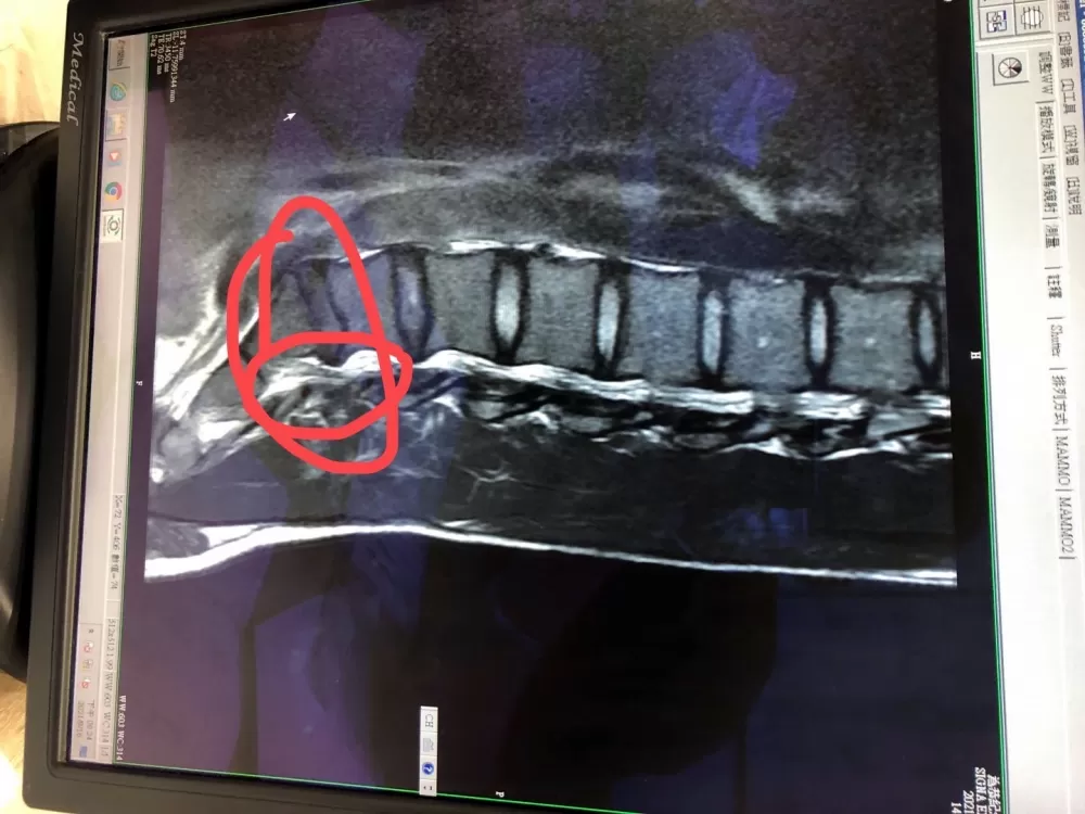 康世峰椎間盤突出。康世峰/提供。
