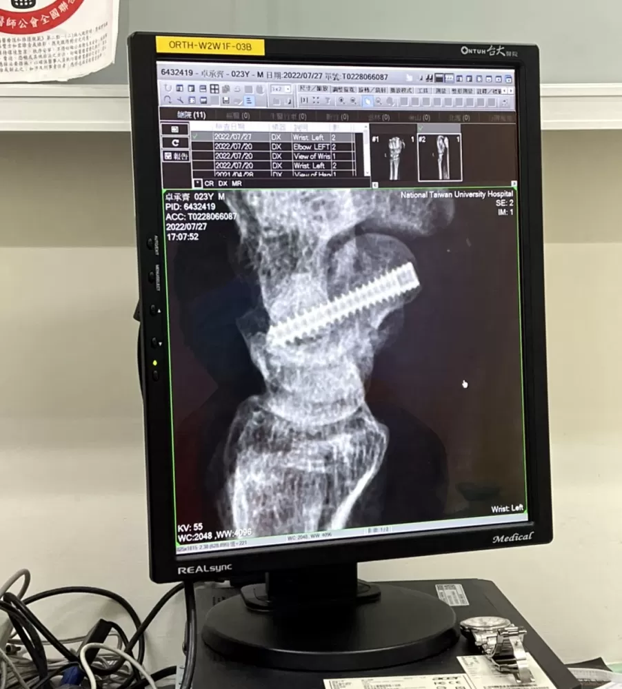 卓承齊車禍後手術，在左手腕植入鋼釘。